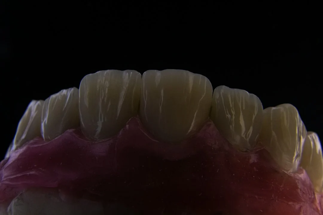 Under-Skin Implant Enables Direct Prosthetic Arm Control